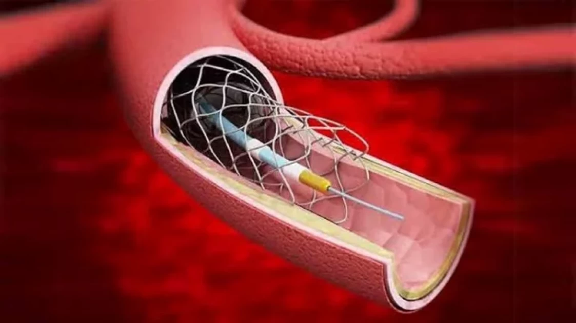 সরকার দাম কমিয়েছে হার্টের রিংয়ের